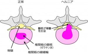 椎間板