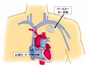 pacemaker