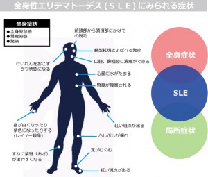 sle