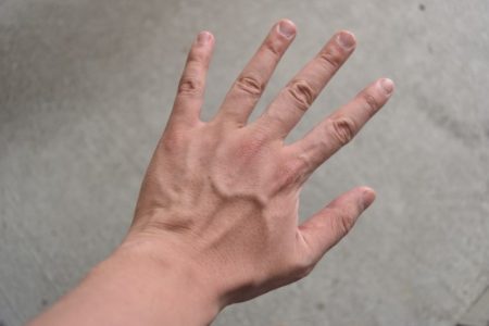 爪周囲炎の症状や原因！何科を受診するかと治し方【自然治癒する？】