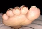 新生児の黄疸・ビリルビンの数値は？光線療法など治療法と費用！
